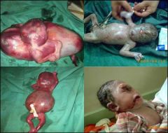 Irak_malformation_enfant_uranium-appauvri_bebe.jpg