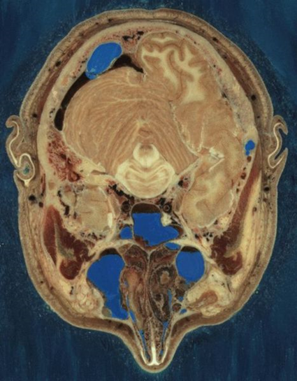 Cryosection de la tte de Joseph Jernigan